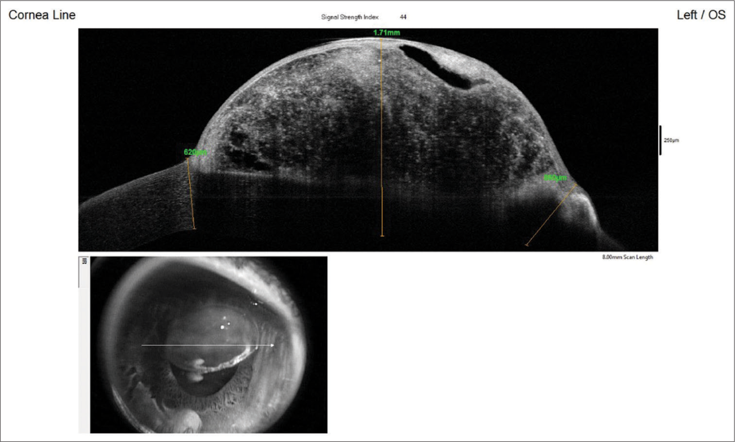 AS-OCT - Anterior segment optical coherence tomography (Optovue, Fremont, CA) image showing cystic lesion of the iris.