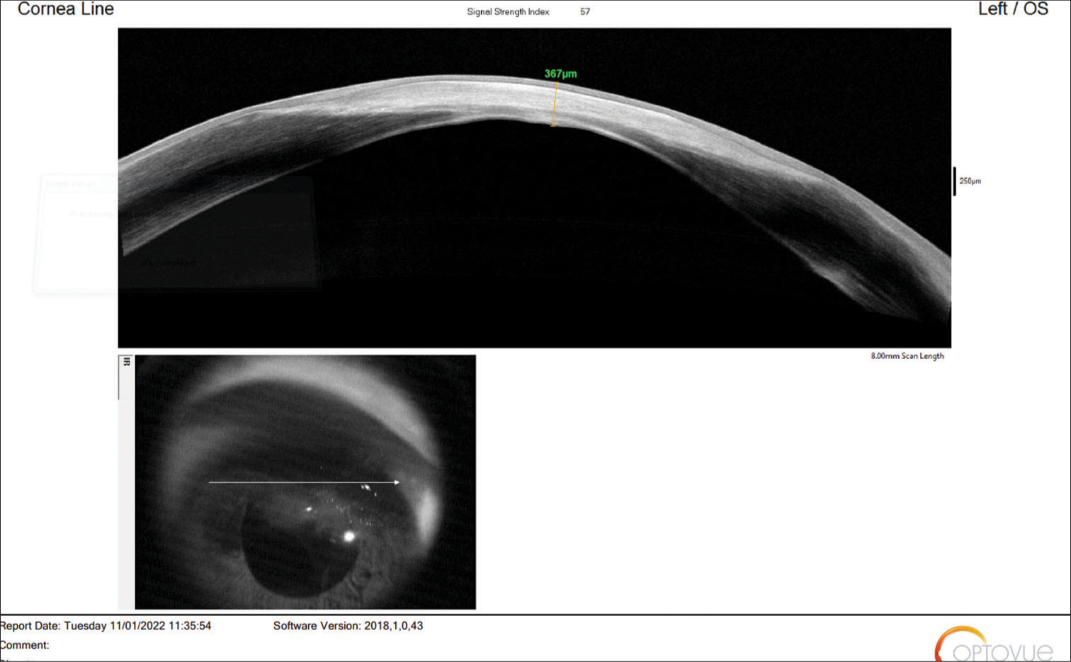 AS-OCT - Anterior segment optical coherence tomography (Optovue, Fremont, CA) image showing fine integration of tenons patch graft in the cornea.