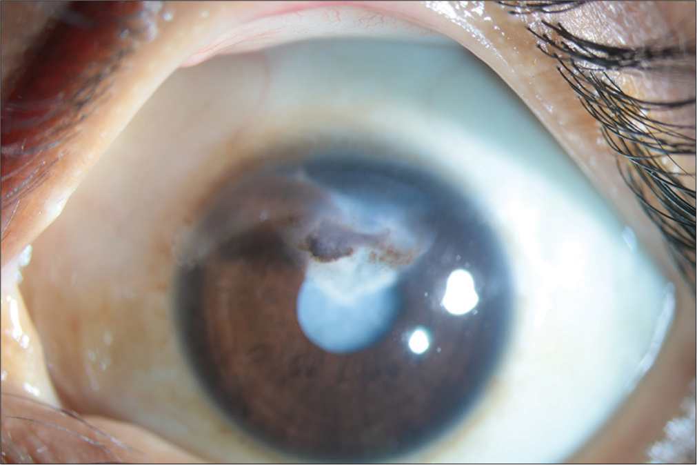 Slit-lamp image showing healing of tenons patch graft with traumatic cataract.