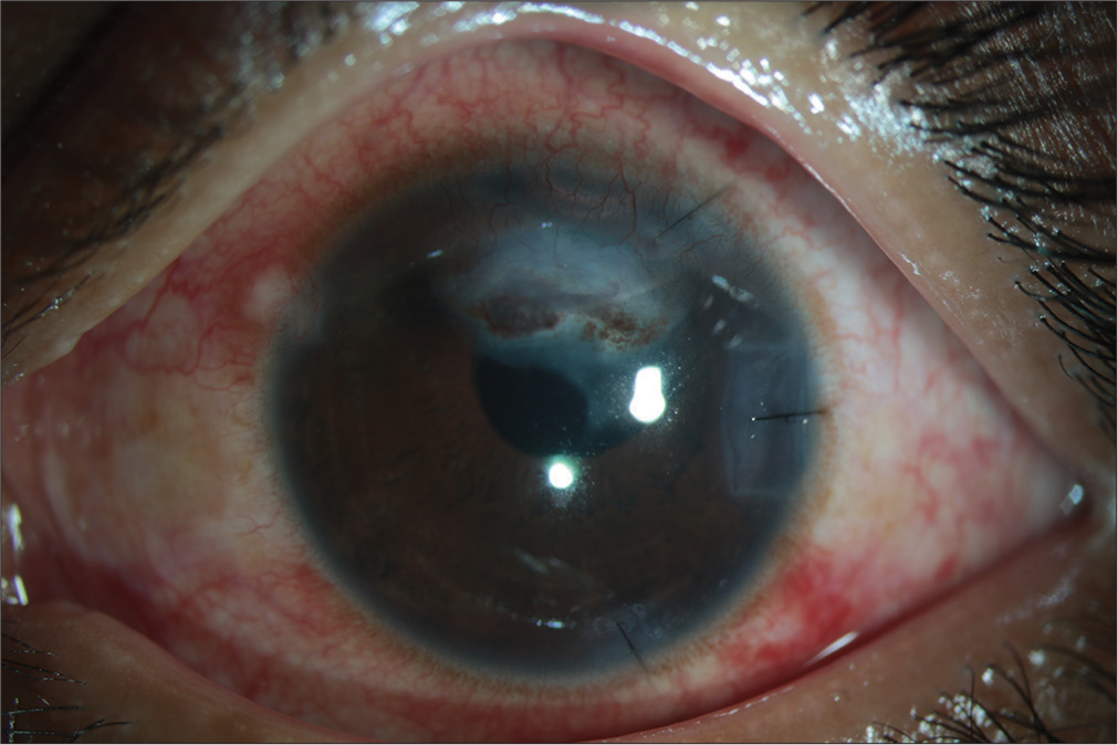 Slit-lamp image of the patient after an uneventful cataract surgery.