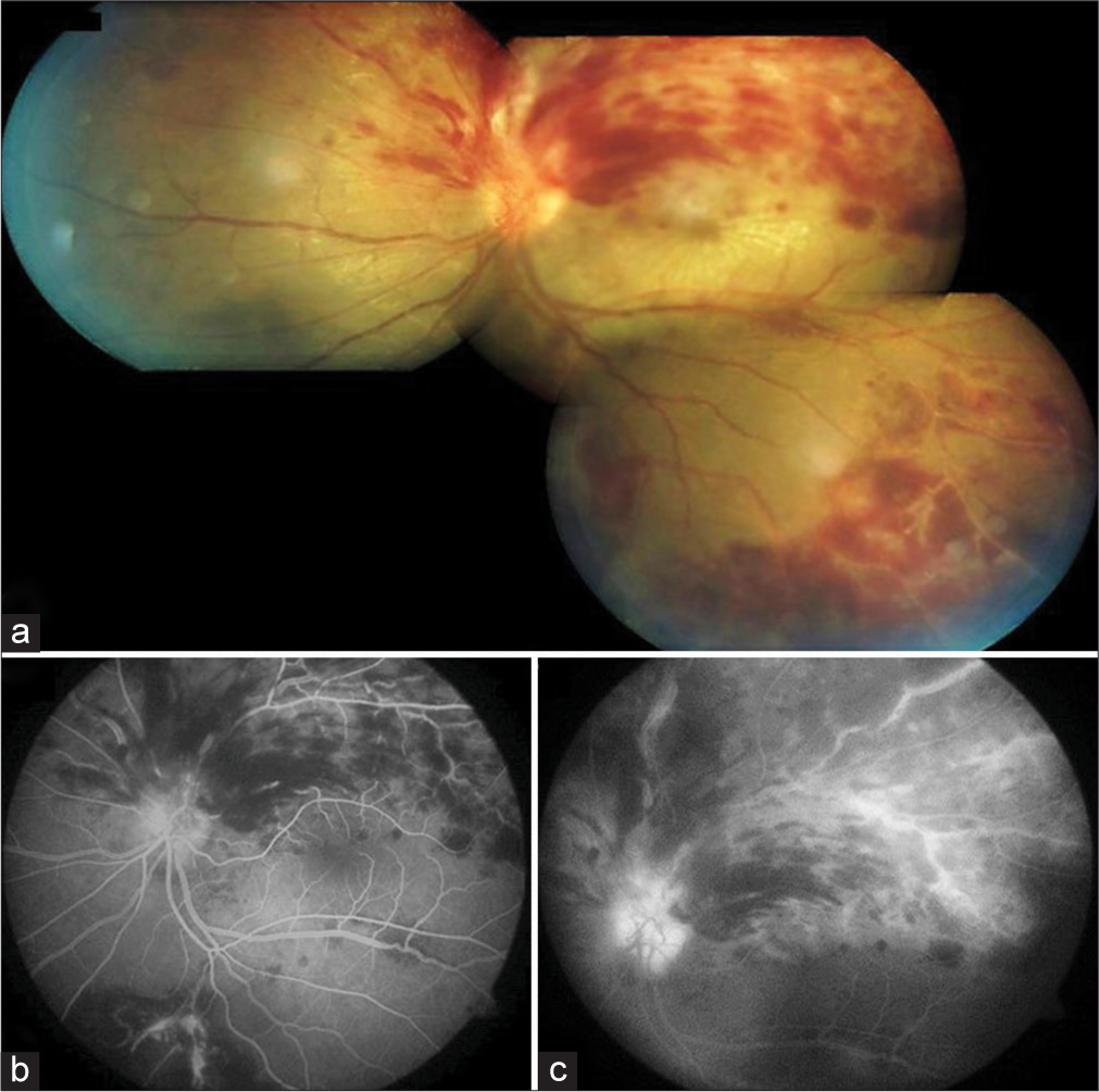 (a) Montage image showing multiple splinter hemorrhages superiorly and occlusive retinal vasculitis inferiorly with partial macular star exudation (b) and (c) after 5 days of intravenous methylprednisolone, fundus fluorescein angiography showing blocked fluorescence corresponding to the retinal hemorrhages. No macular edema was seen.