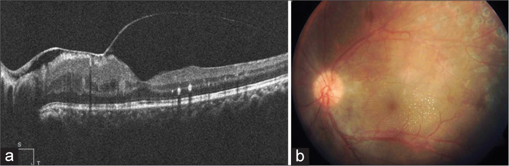 (a) Showing no cystoid macular edema. (b) Significantly resolved hemorrhages and exudates are seen with laser photocoagulation scars.