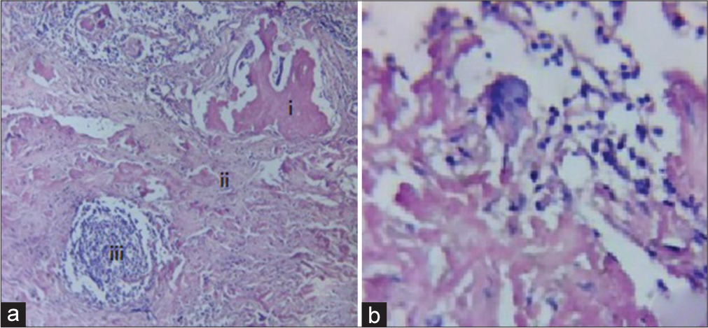 (a) Well-circumscribed encapsulated lesion comprising of (i) osteoid fragments, (ii) fibrous tissue and lymphocytes in the stroma with osteoclastic giant cells, and (iii) lymphoid follicle; (b) osteoclastic giant cell.