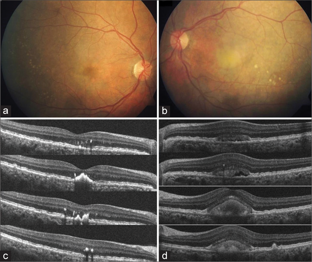 (a) Showing subfoveal scar and subretinal drusenoid deposits. (b) Showing classic egg-yolk lesion and subretinal drusenoid deposits. (c) Showing high-definition-optical coherence tomography (HDOCT) scans of the right eye with subfoveal hyper-reflective material with loss of ellipsoid zone. (d) Showing HD-OCT scans of the left eye with a subfoveal hypo-reflective material with ellipsoid zone and retinal pigment epithelium thickening.