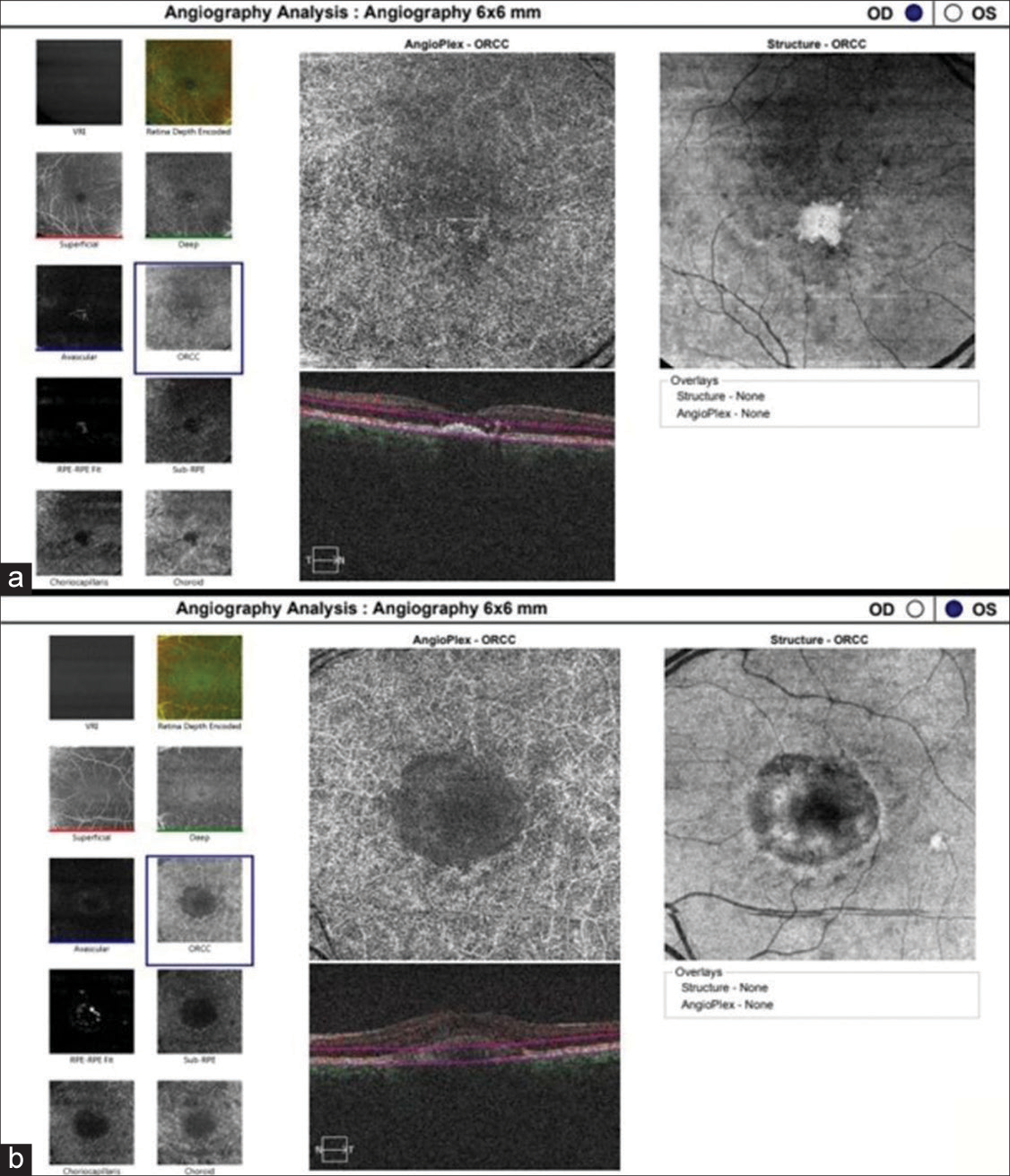 (a) Optical coherence tomography angiography of outer retina to choriocapillaris zone of the right eye, (b) left eye demonstrating no evidence of any vascular network or other vascular abnormality. OD: oculus dexter (right eye), OS: oculus sinister (left eye), ORCC: outer retina to choriocapillaris.