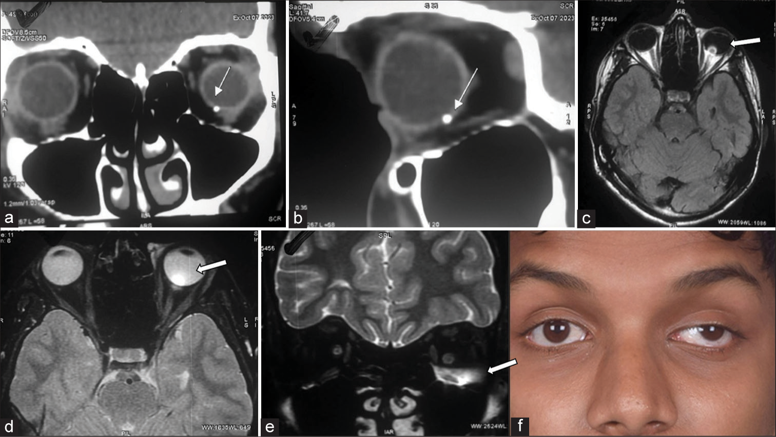 (a and b) show the round, small, hyperintense foreign body of 1mm in the inferior sclera in the coronal and sagittal section of the CT orbit, respectively (arrows). (c and d) show hyperintense foreign bodies in the axial section of the MRI orbit (arrows). (e) shows hyperintensity involving the inferior rectus muscle of the orbit (arrow). (f) shows the clinical appearance of the patient concerned (arrow).