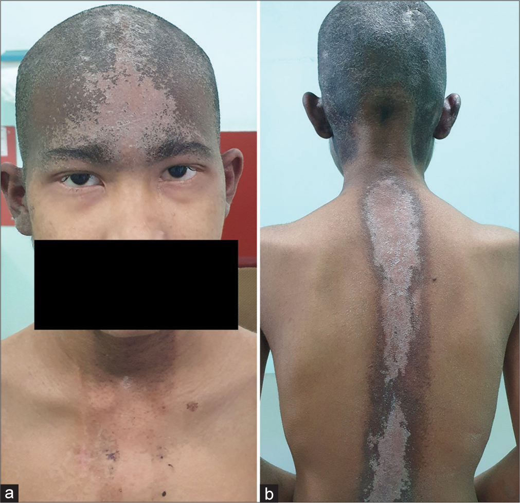 (a) Madarosis in lower eyelids and radiation dermatitis on the head and (b) Dermatitis along the head and spine region which received radiation.