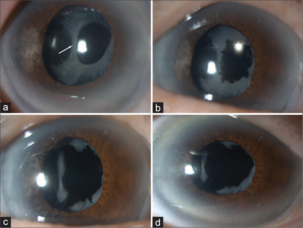 An 88-year-old male with weak zonules, small pupil requiring iris hooks and on an alpha-1 blocker (tamsulosin) – post-cataract surgery with an odd configuration of anterior capsule contraction syndrome. Slit-lamp photos showing (a) central pillar of fibrosis (white arrow) and clear region of capsule temporally, (b) after first Neodymium: Yttrium-aluminium-garnet (Nd: YAG) laser radial anterior capsulotomy, (c) after second Nd: YAG laser radial anterior capsulotomy, and (d) after third Nd: YAG laser radial anterior capsulotomy showing that the previously noted central pillar has shifted temporally out of visual axis.