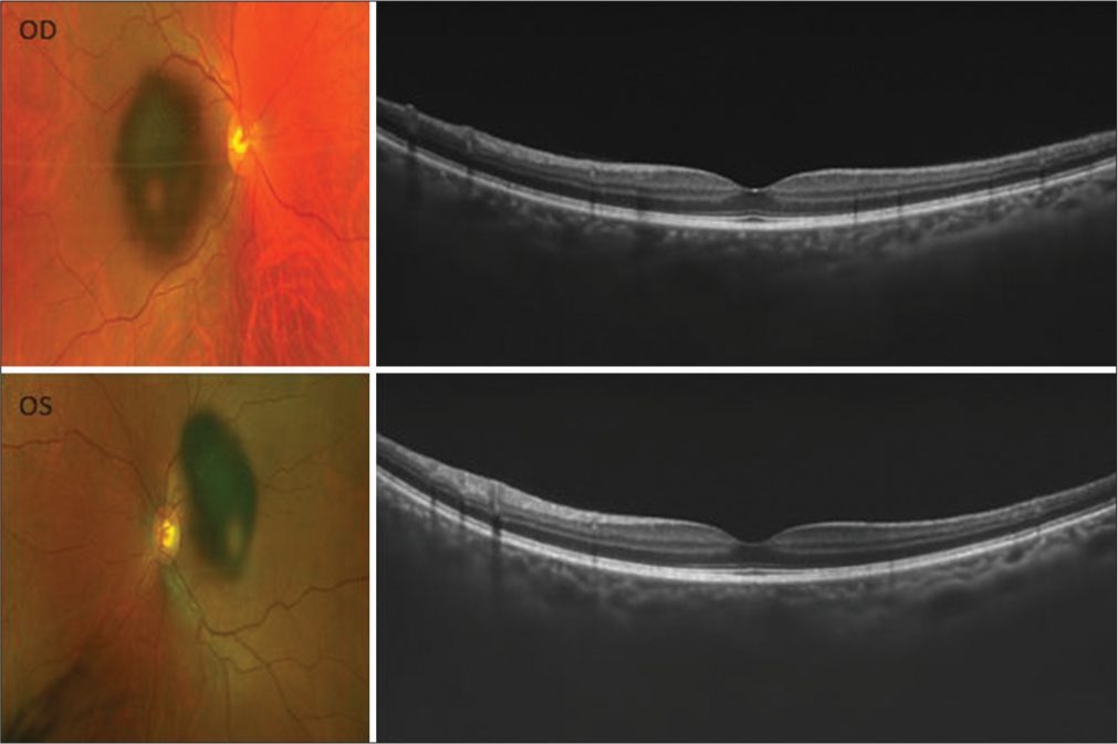 Fundus photo (Left) and optical coherence tomography (Right) of right (Top) and left (Bottom) eye.