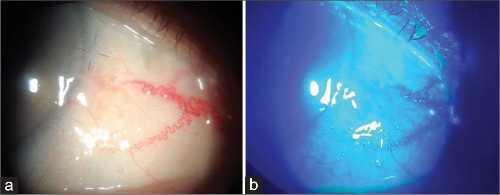 After completion of three cycles of treatment, (a) No gross lesion seen but still with feeder vessels. (b) Minimal punctate staining of the lesion with fluorescein dye.