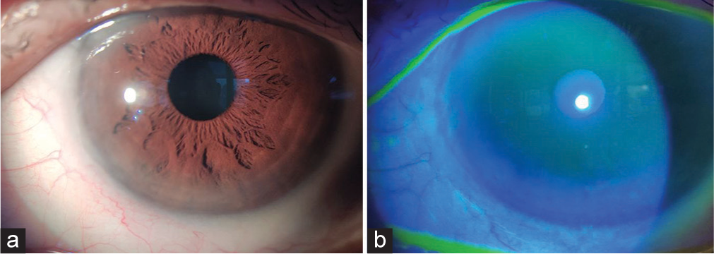 After completion of three cycles of treatment, (a) lesion on the cornea barely visible on slit-lamp examination. (b) No epithelial lesion was seen on the cornea and no dye uptake with fluorescein.