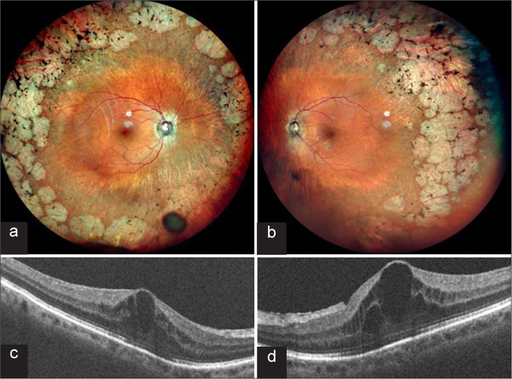 A 76-year-old lady, a known case of gyrate atrophy presented to us showing (a and b) multiple, peripheral discrete patches of chorioretinal atrophy along with bony spicules. (c and d) Optical coherence tomography showing cystic spaces suggestive of cystoid macular edema.