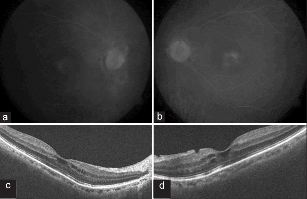 (a and b) Fundus fluorescein angiography late phase demonstrating petaloid pattern suggestive of cystoid macular edema. (c and d) One month after dexamethasone implant showing significantly resolved cystoid macular edema.