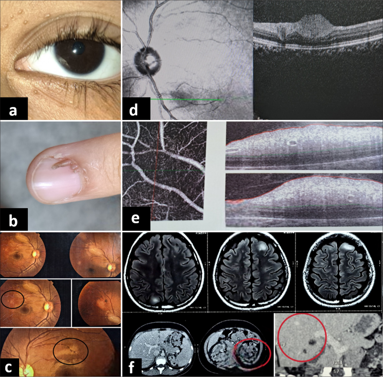 (a) Molluscum pendulum lesions on eyelids, (b) sub ungual fibroma, (c) white translucent retinal lesions with indistinct margins at the posterior pole of both eyes, (d) and (e) dome shaped hyperreflective lesions in retinal nerve fibre layer on spectral domain optical coherence tomography, and (f) contrast-enhanced computed tomography chest and abdomen showing multiple nodular lesions in lungs suggestive of lymphangiomatosis (red circles) and possible angiomyolipoma in liver and both kidneys.