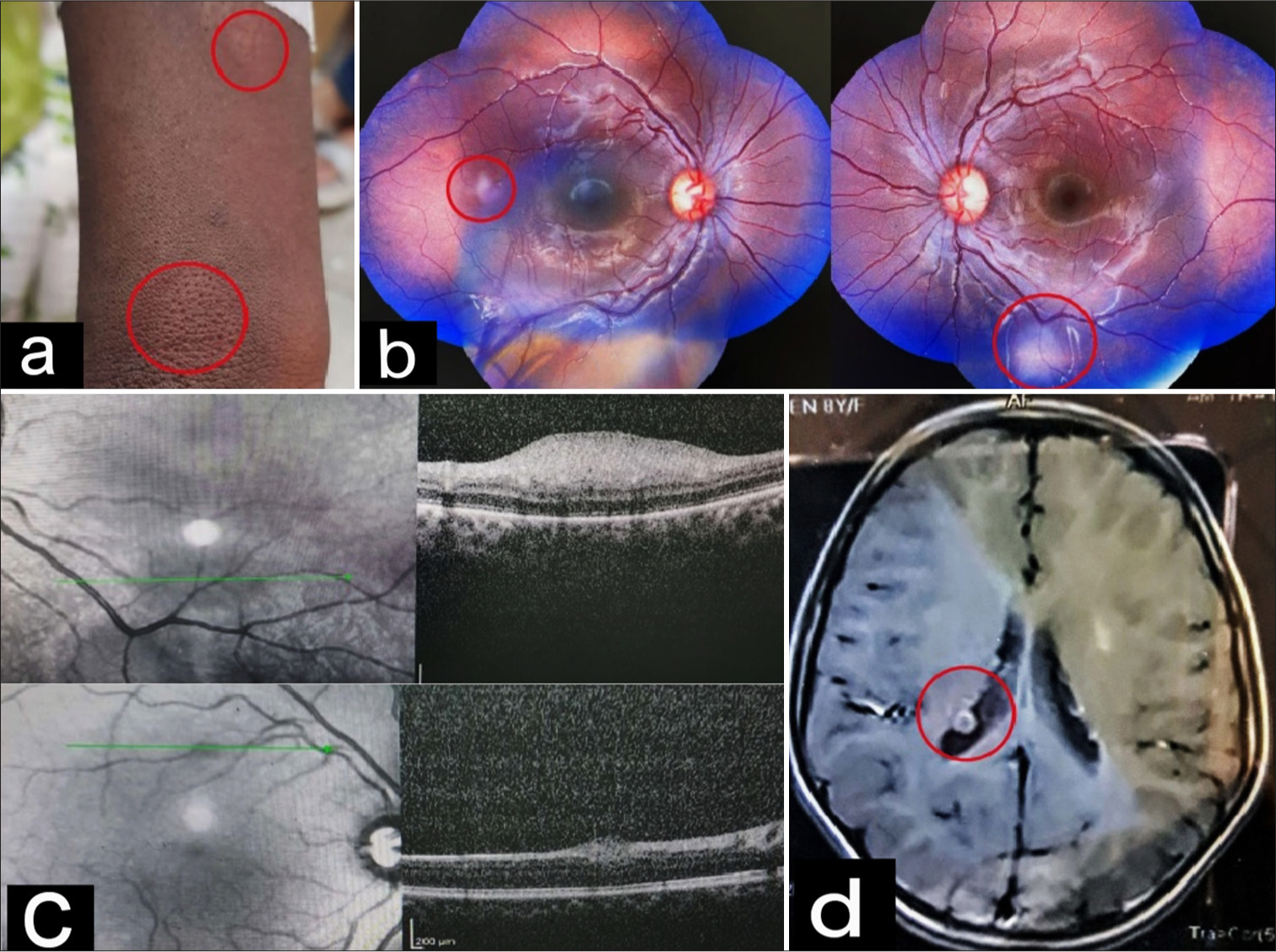 (a) Shagreen patches and ash leaf macules on the forearm (as marked in red circle), (b) a flat salmon-colored translucent lesion with indistinct margins in the right eye and a larger whitish translucent lesion in the left eye (as marked in red circles), (c) dome-shaped hyper-reflective lesions in retinal nerve fiber layer on spectral domain-optical coherence tomography, and (d) magnetic resonance imaging brain showing subependymal nodules and cortical tubers (as marked by red circle).