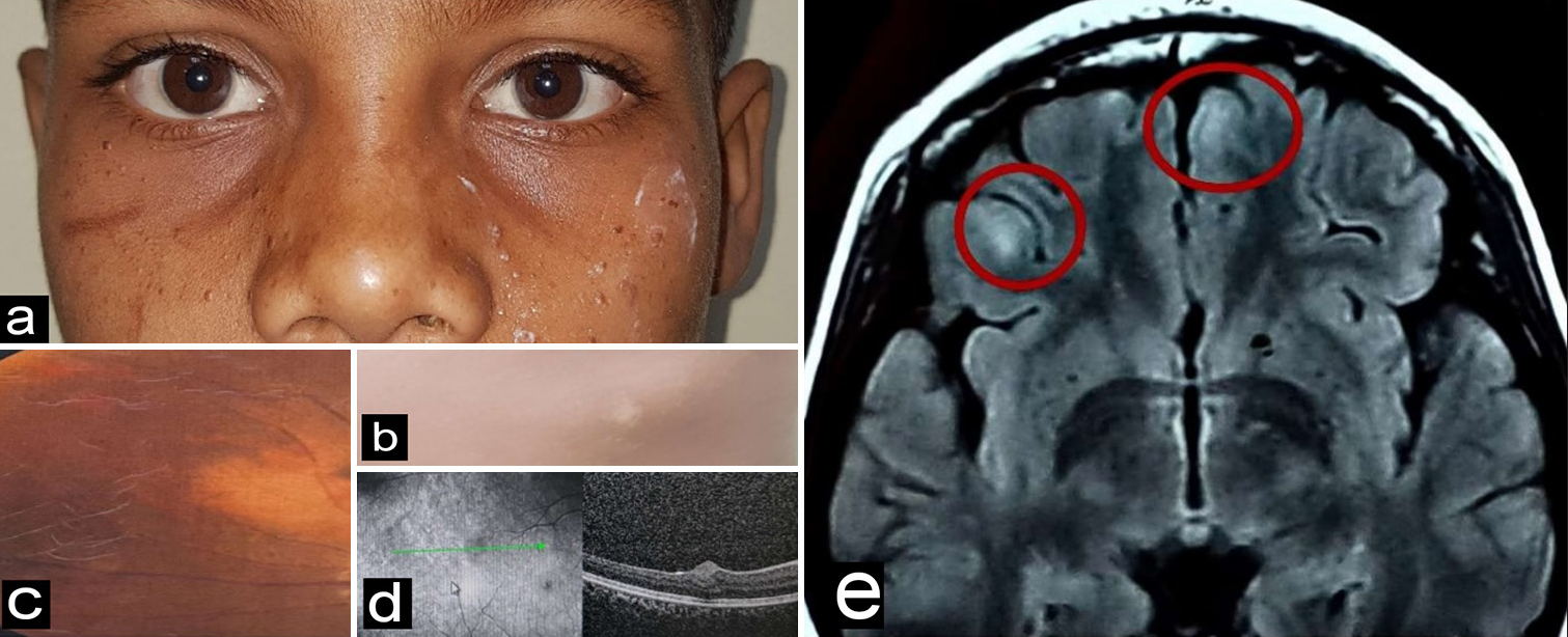 (a) Multiple facial angiofibromas, (b) hypopigmented ash leaf macule, (c) a flat white translucent lesion with indistinct margins, (d) dome-shaped hyperreflective lesion in retinal nerve fiber layer on spectral domain-optical coherence tomography, and (e) Magnetic resonance imaging brain showing two small cortical tubers (as marked by red circles).