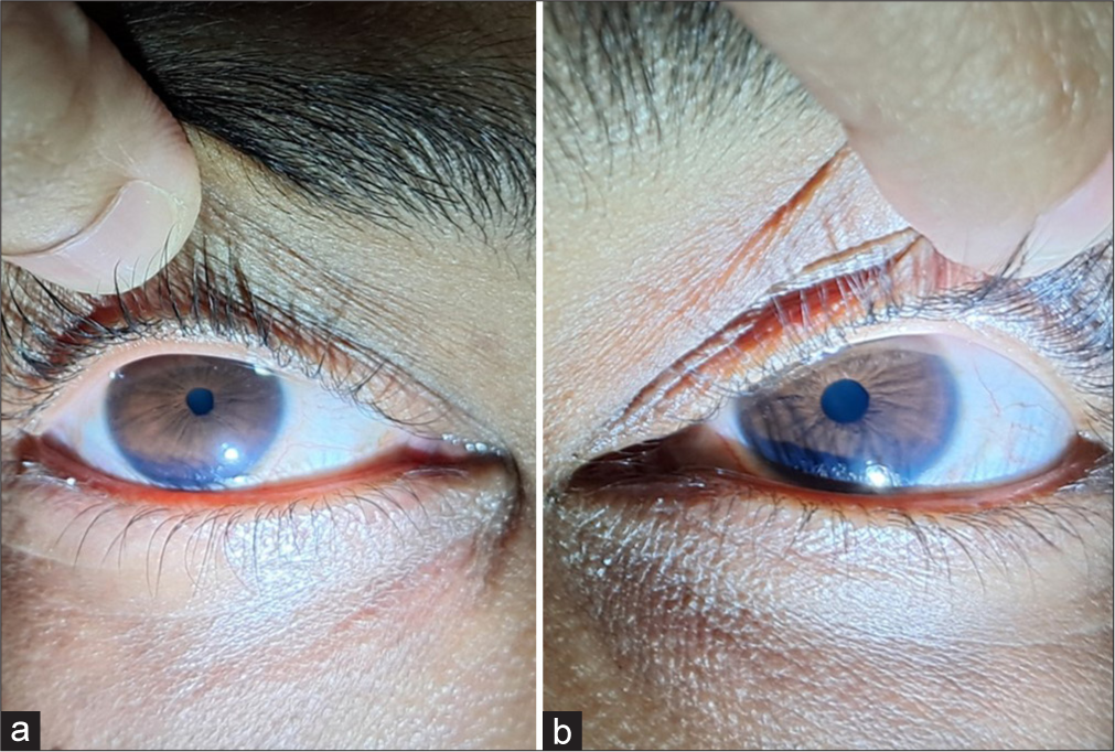 (a and b) Right eye miotic pupil and left eye normal pupil.