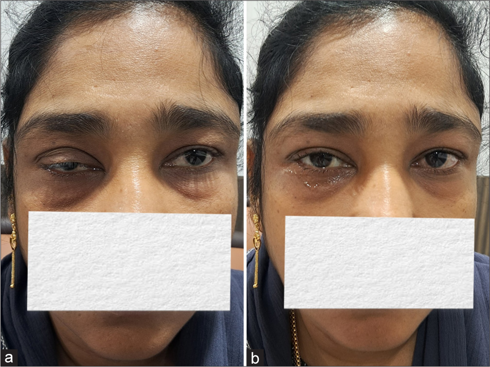 (a and b) Right-sided ptosis showing improvement after topical phenylephrine.