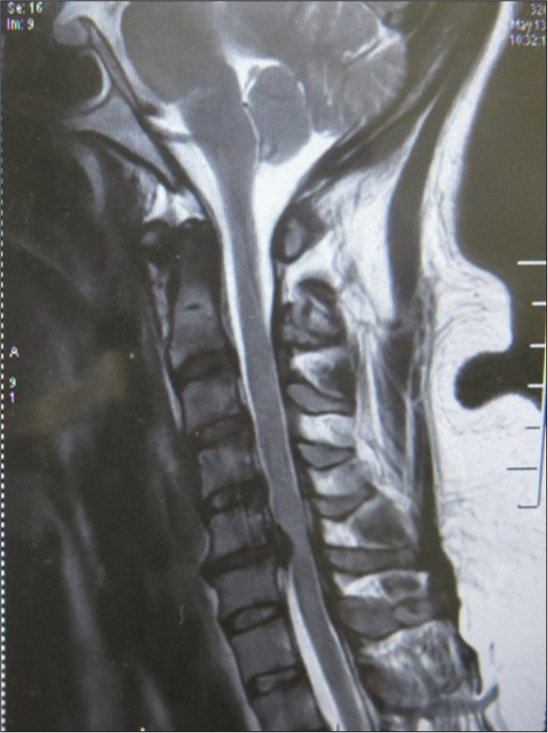 Cervical compression at the level of C5-C6.